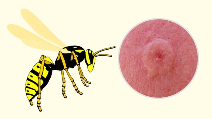 10 Bug Bites Anyone Should Be Able to Identify