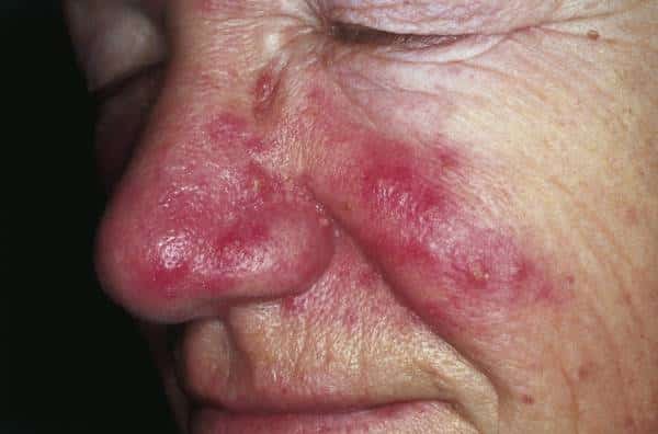 Skin Conditions: Top 10 Most Common