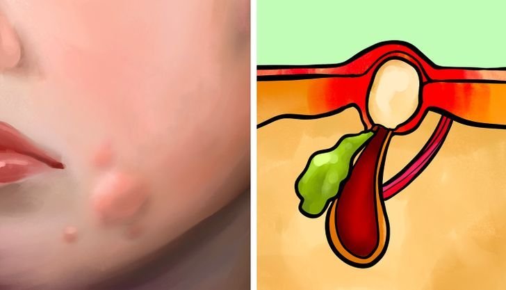 Cysts